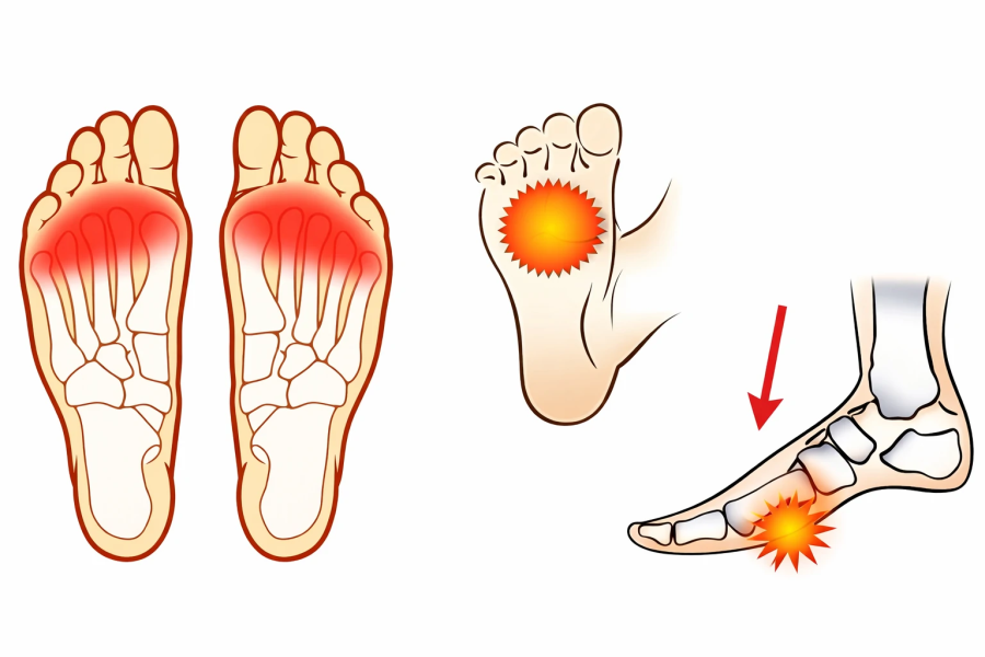 Боль в плюсне стопы: причины, диагностика и современные варианты лечения 