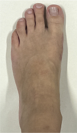 Нallux valgus, операция Scarf (открытая)
