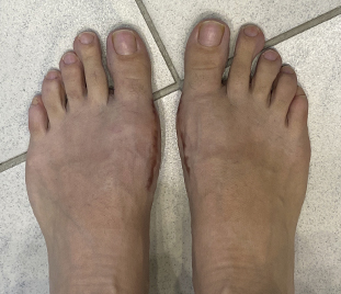Нallux valgus, операция Scarf (открытая)