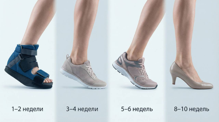Когда можно ходить, бегать и носить каблуки после операции на hallux valgus