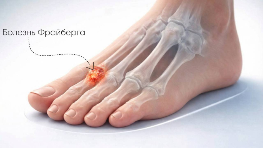 Болезнь Фрайберга