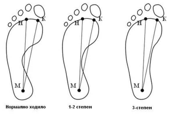 Причины плоскостопия