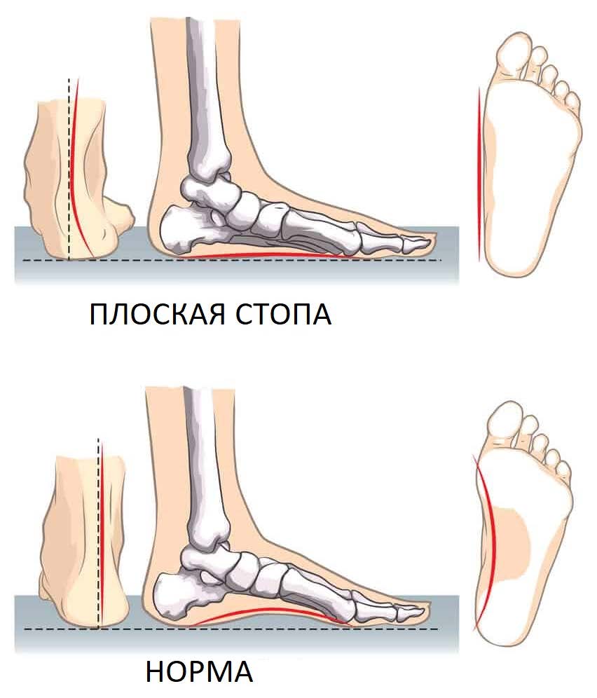 Типы плоскостопия
